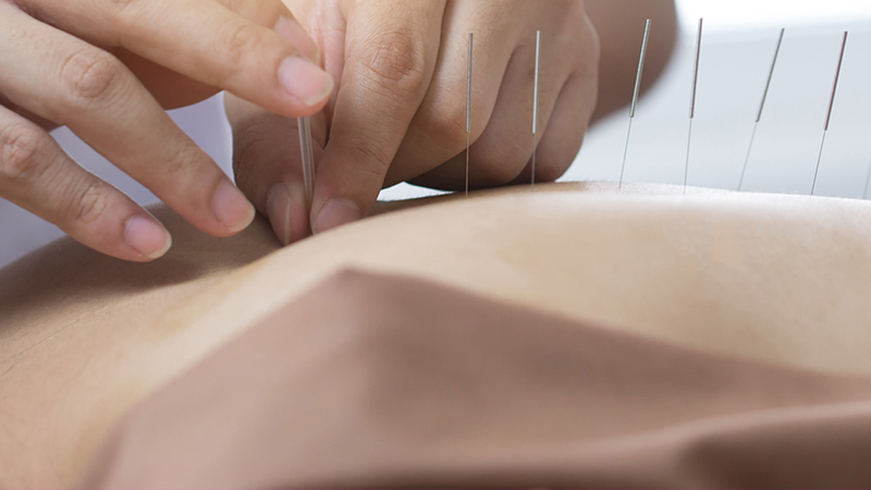 Acupuncturist inserting a needle into a patient's back.