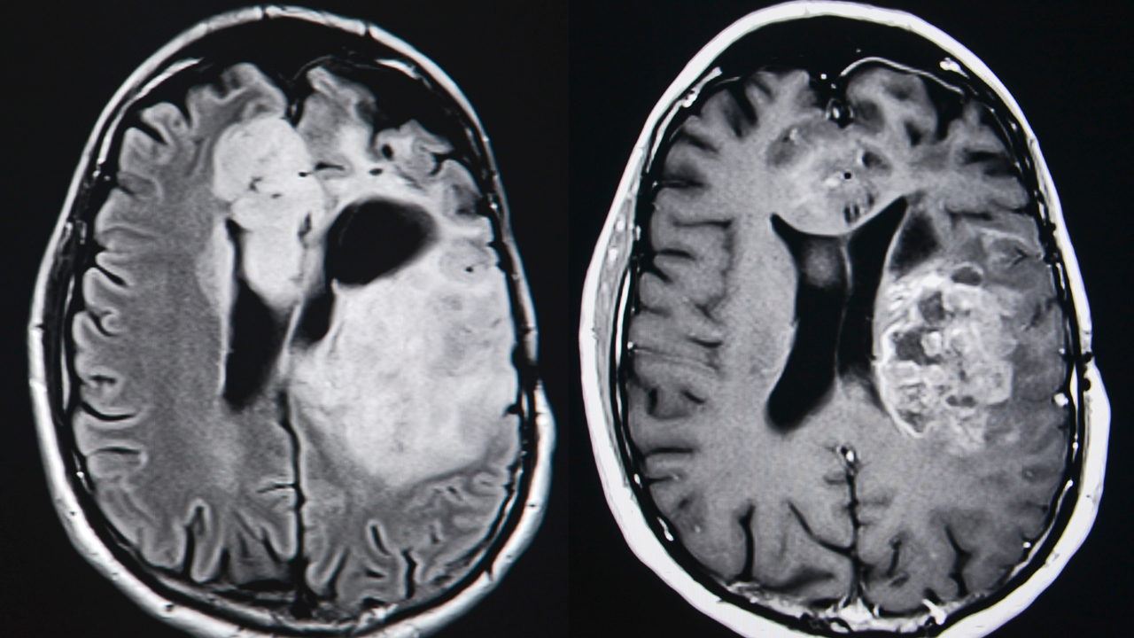 nm-brain-tumors-feature
