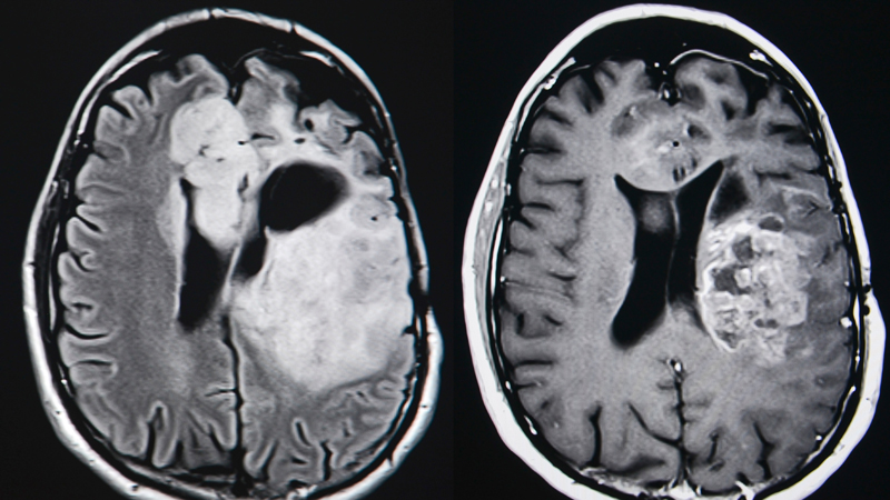 nm-brain-tumors-tnail