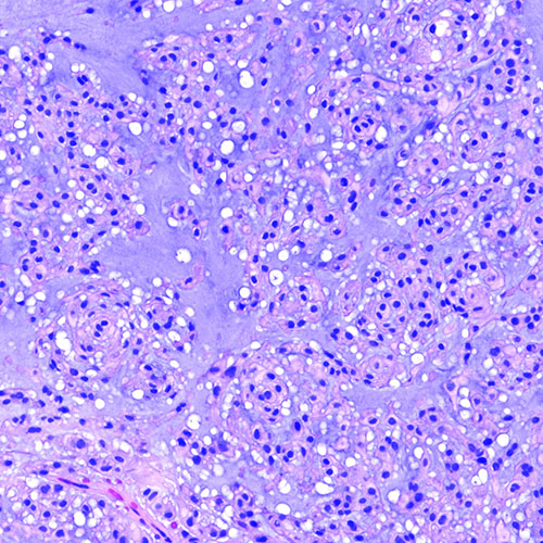 nm-brain-tumors-up-close-chordoma-100x
