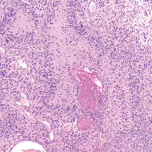 nm-brain-tumors-up-close-glioblastoma-40x