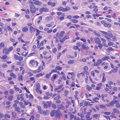 nm-brain-tumors-up-close-meningnoma
