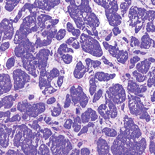 nm-brain-tumors-up-close-mets-mucinous-breast2