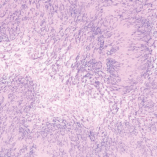 nm-brain-tumors-up-close-schwannoma-40x