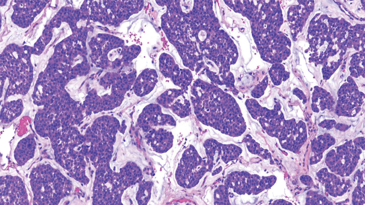 nm-brain-tumors-up-close_feature