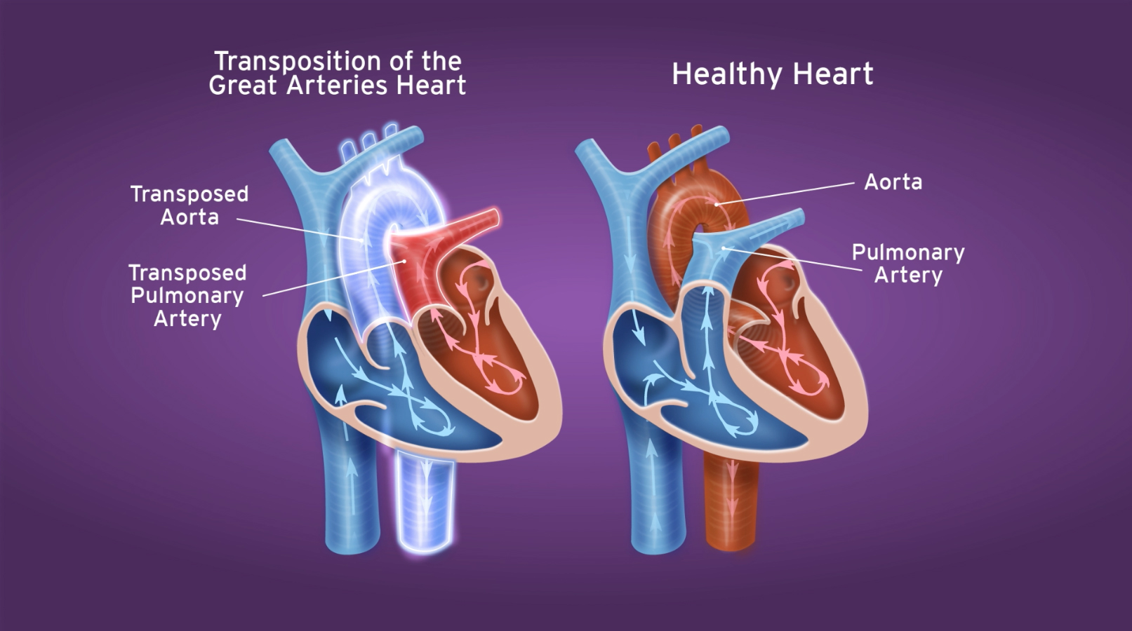 A diagram showing the anatomy of a heart with transposition of the great arteries.