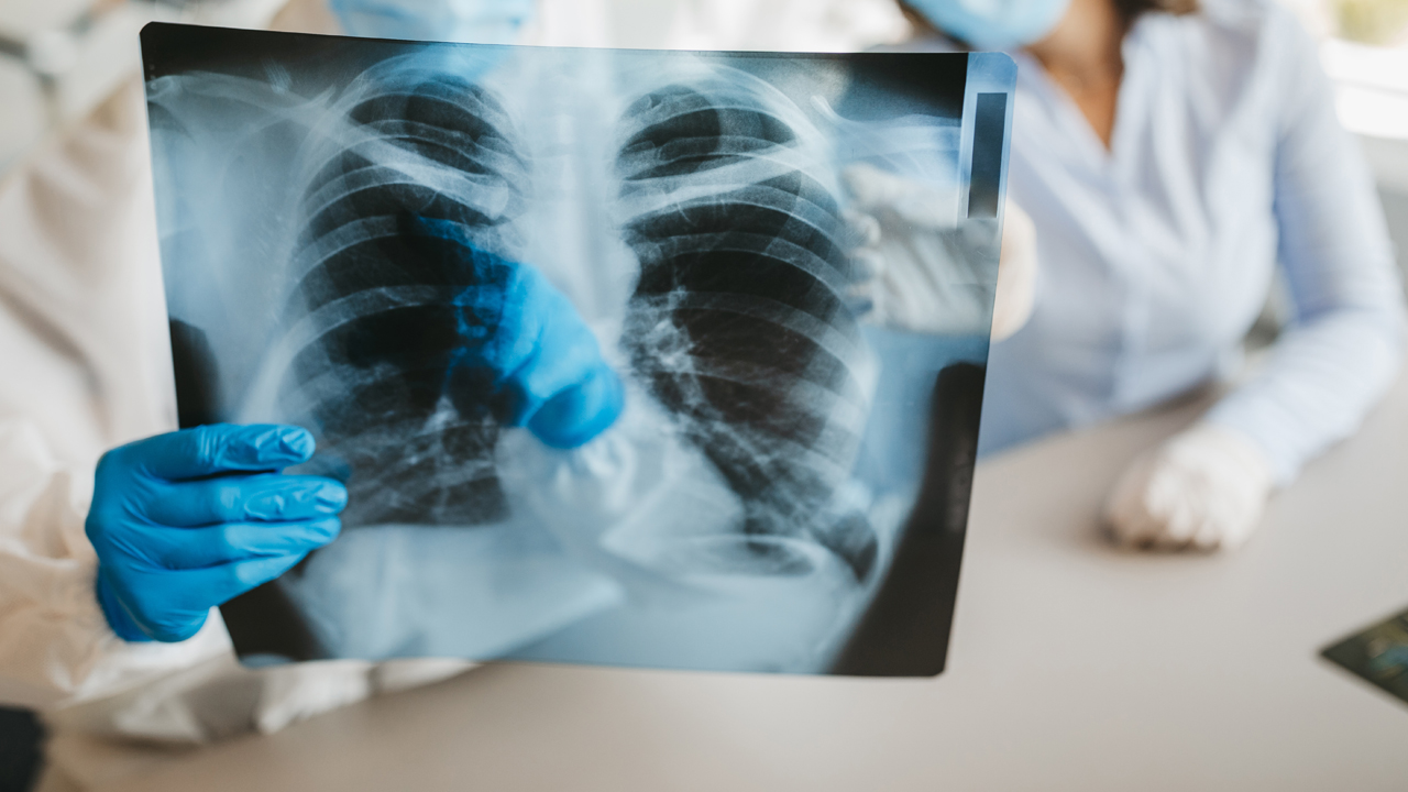 A-Team-Approach-to-Lung-Blood-Clots_ft