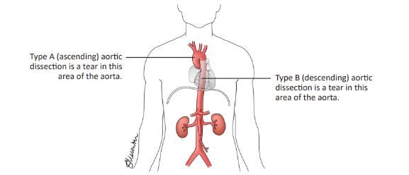 Illustration of a type A and type B aortic dissection.