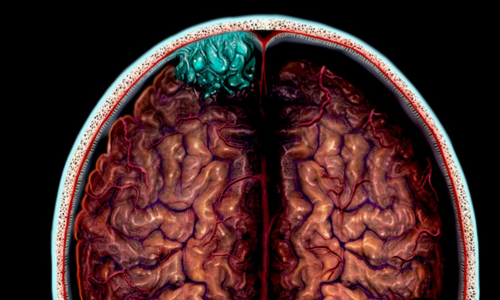 A scan of a brain tumor.