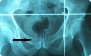 Radiografía de implantación de semillas