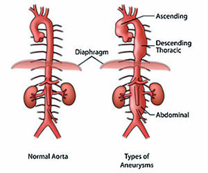 Types for Aneurysms