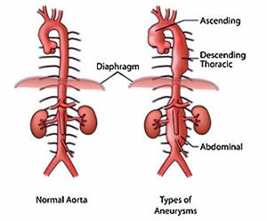 thoracic-aortic-aneurysm-comparison