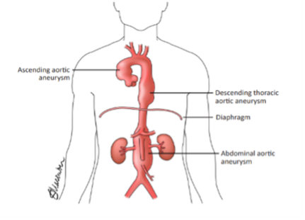 thoracic-aortic-2