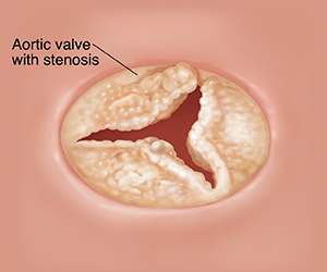 Illustration of aortic valve