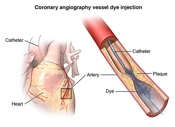 Coronary angiography vessel dye injection