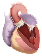 Aortic Valve in Valve Replacement
