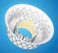 Intrepid Transcatheter Mitral Valve Replacement (TMVR) System