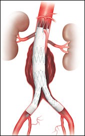 Endovascular Grafts in the Body