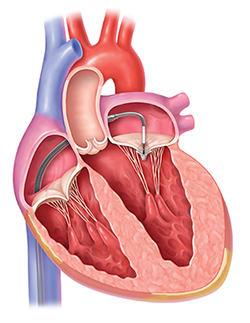 Heart illustration of fixed mitral valve