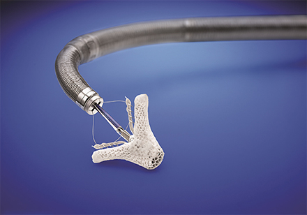 Mitral valve replacement