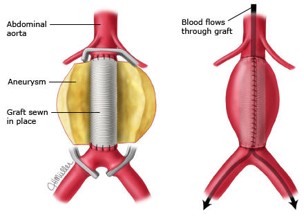 Diagram of the abdominal aorta, an aneurysm, and a graft in place.