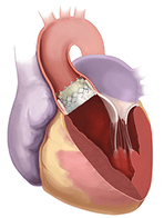 TAVR Valve