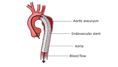 Endovascular Options For Aortic Aneurysm Northwestern Medicine Endovascular Options For Aortic Aneurysm Northwestern Medicine
