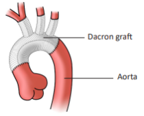 total-aortic-arch
