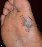 picture of acral melanoma