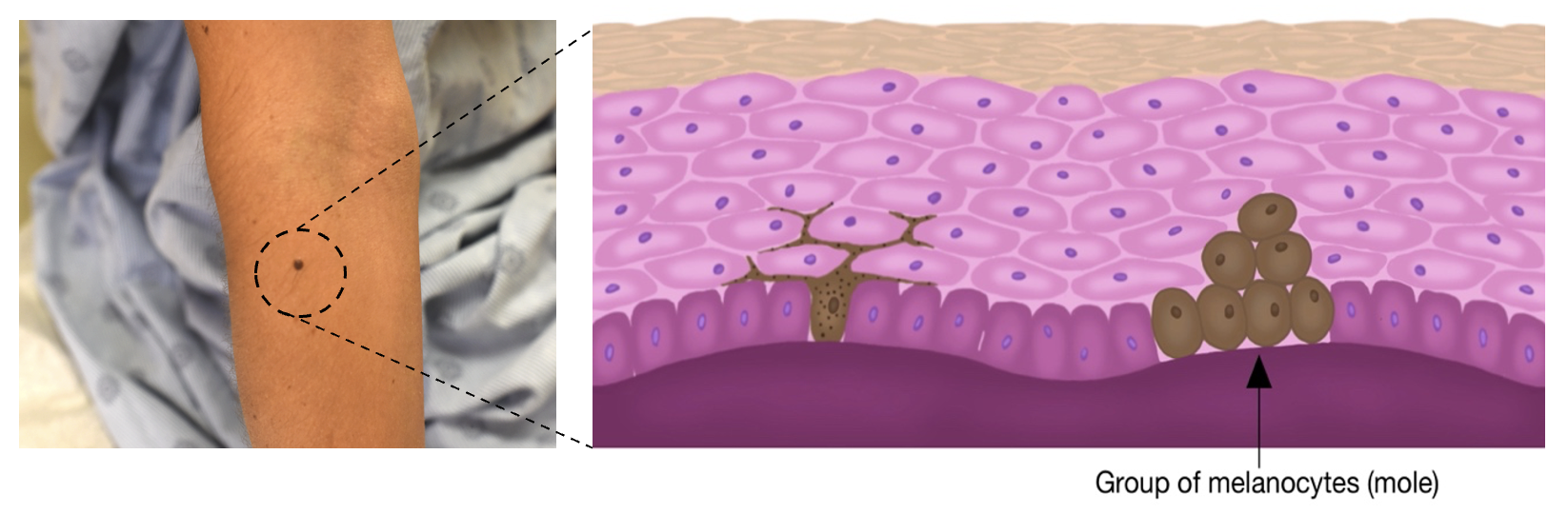 A mole and what the cells look like
