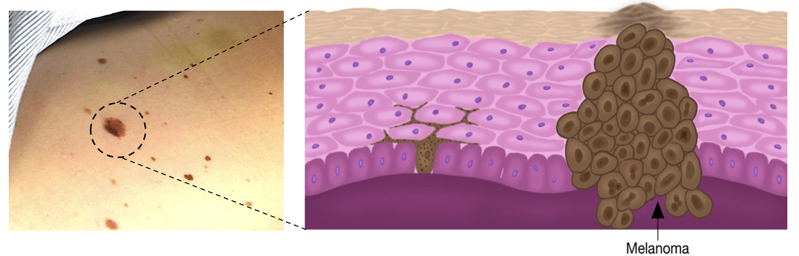 What melanoma could look like and the cells