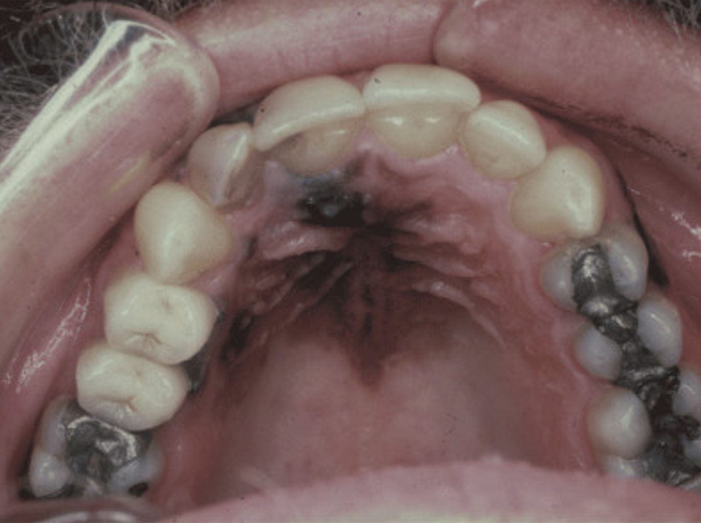example of Mucosal Melanoma
