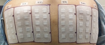 Photo of a patch test.
