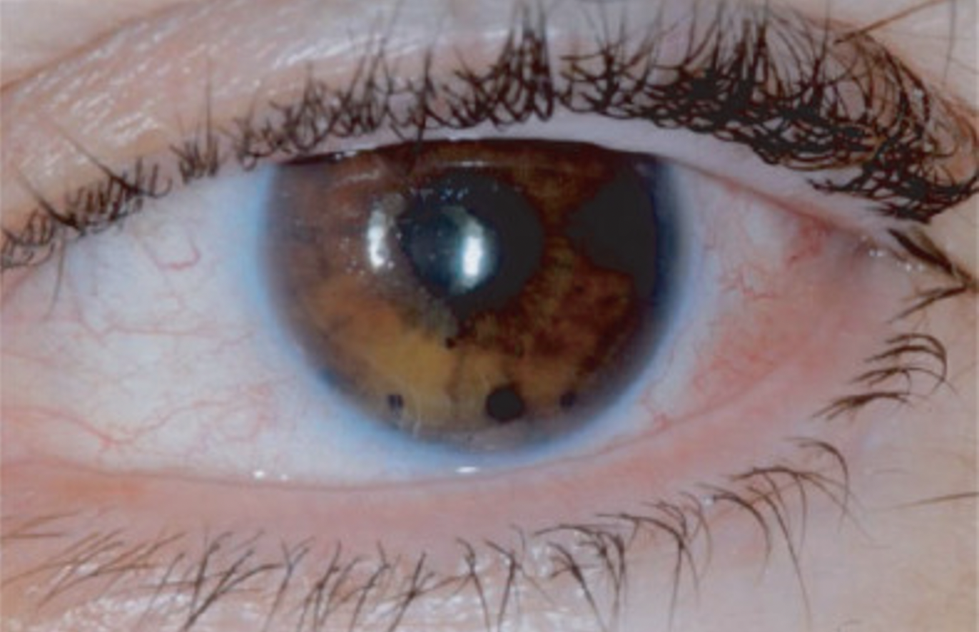 Uveal Melanoma example