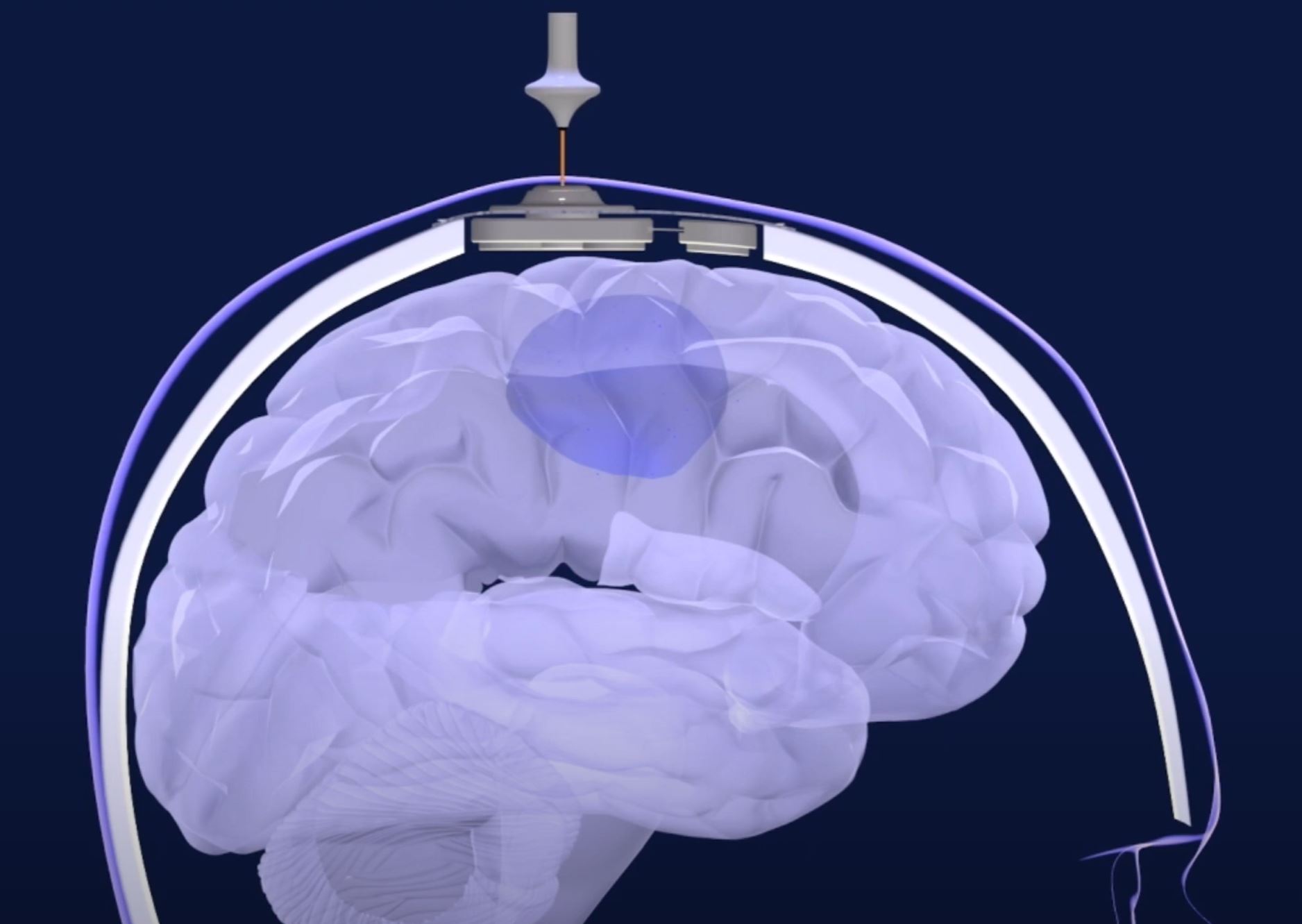Sonication skull implantable ultrasound
