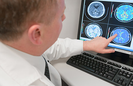 A Northwestern Medicine physician examining a brain scan to diagnose epilepsy.