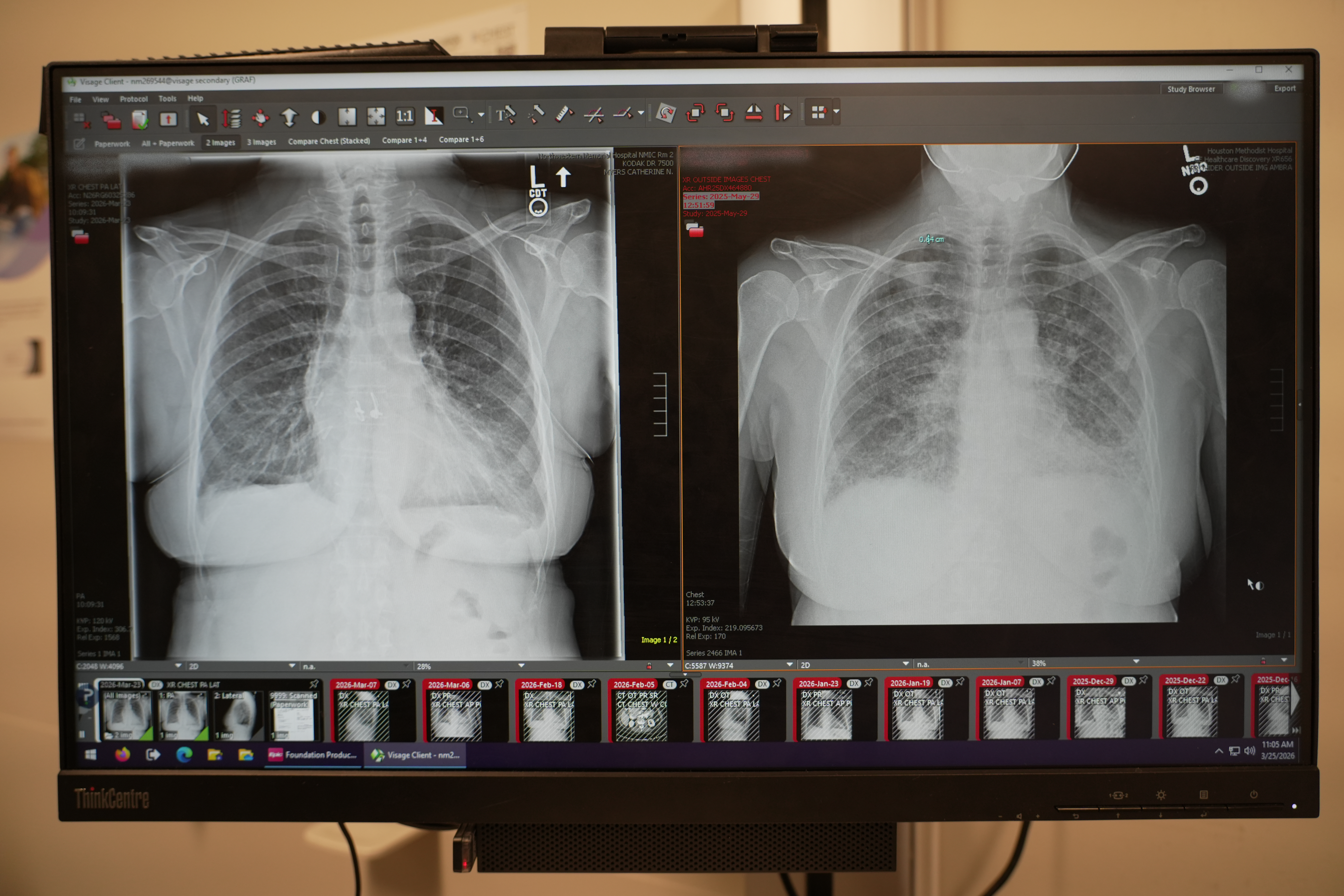 Computer monitor displaying side-by-side chest X-ray images used to evaluate lung health and transplant outcomes.