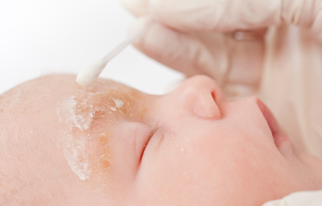 Northwestern Medicine baby getting ointment applied to face