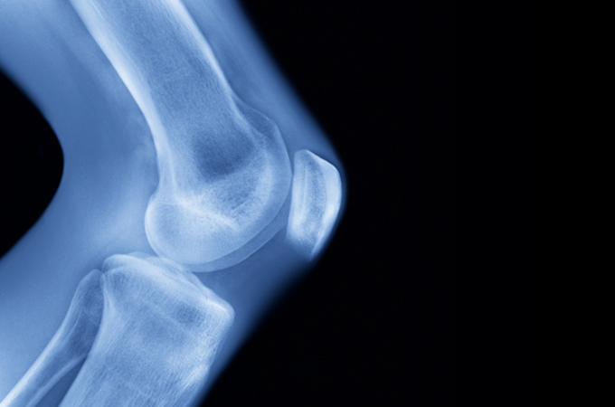An X-ray of a knee