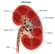 Diagram of Kidney with Kidney Stones