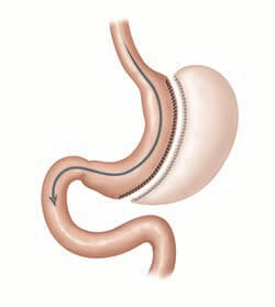 Sleeve Gastrectomy illustration