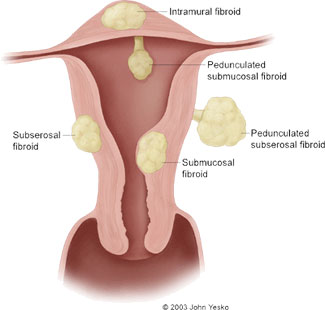 Diagram of Uterine Fibroids