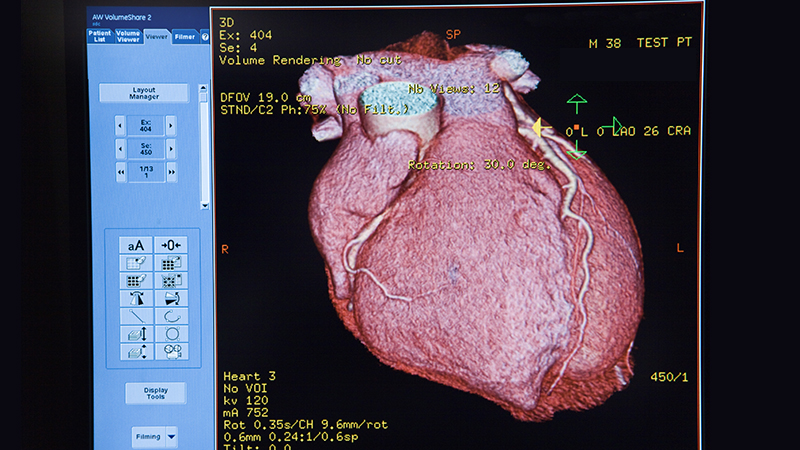 Image of a heart scan shown on a computer program.