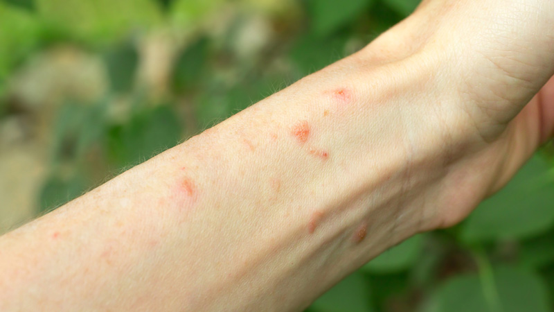 Poison ivy rash on an arm.