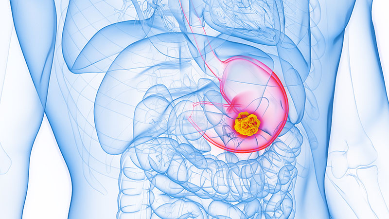 An illustration of stomach cancer.