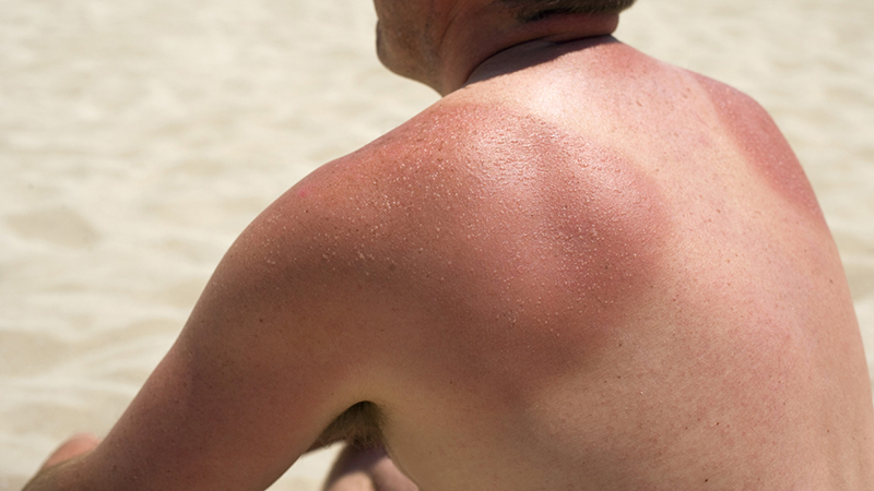 Person sitting on the beach with deeply sunburnt shoulders.